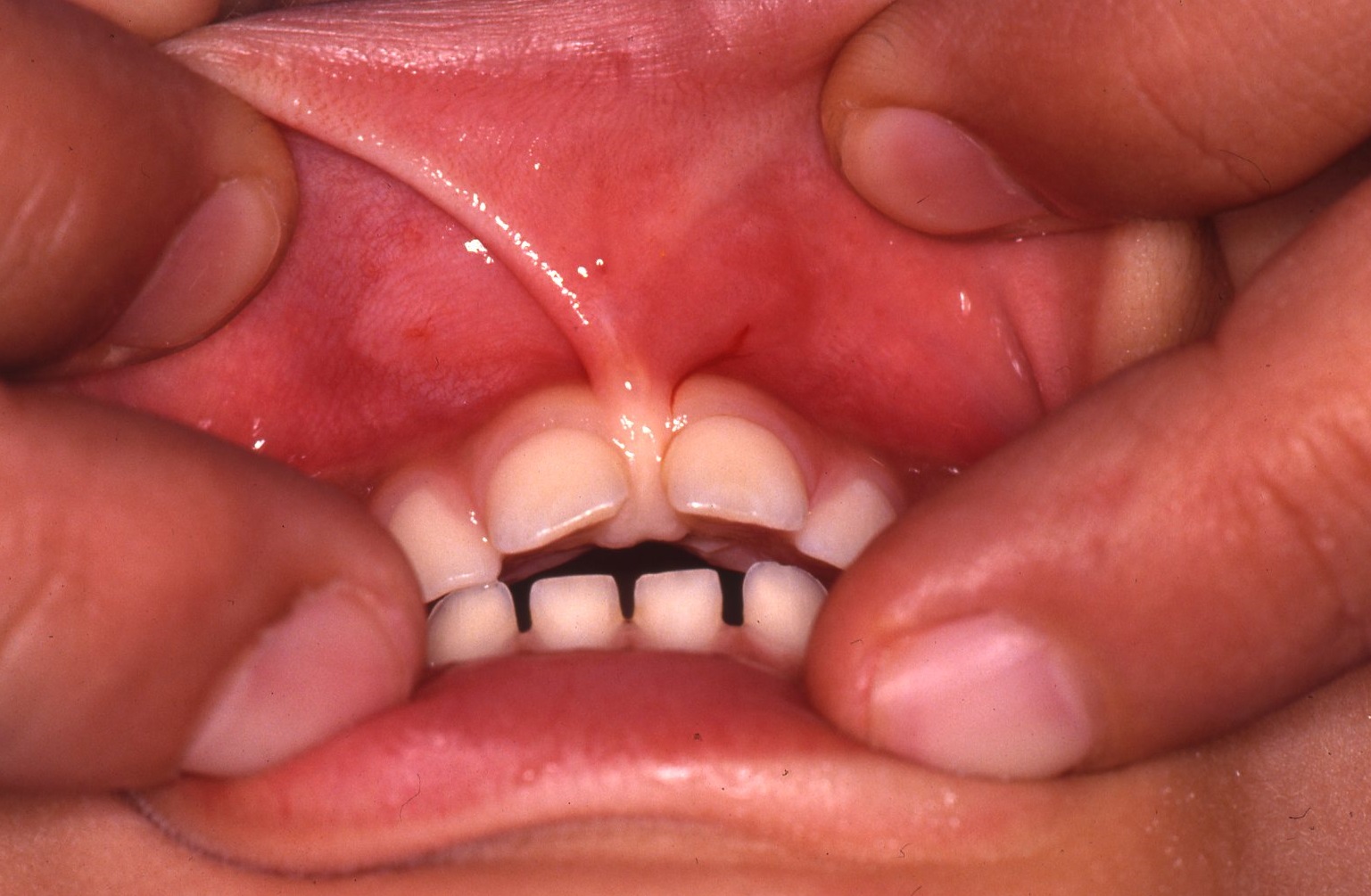 上唇小帯について 小児歯科専門の二子玉川ステーションビル矯正・歯科