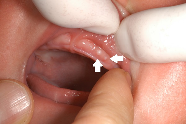 新生児期・乳児期にみられる歯のようなもの（上皮真珠）