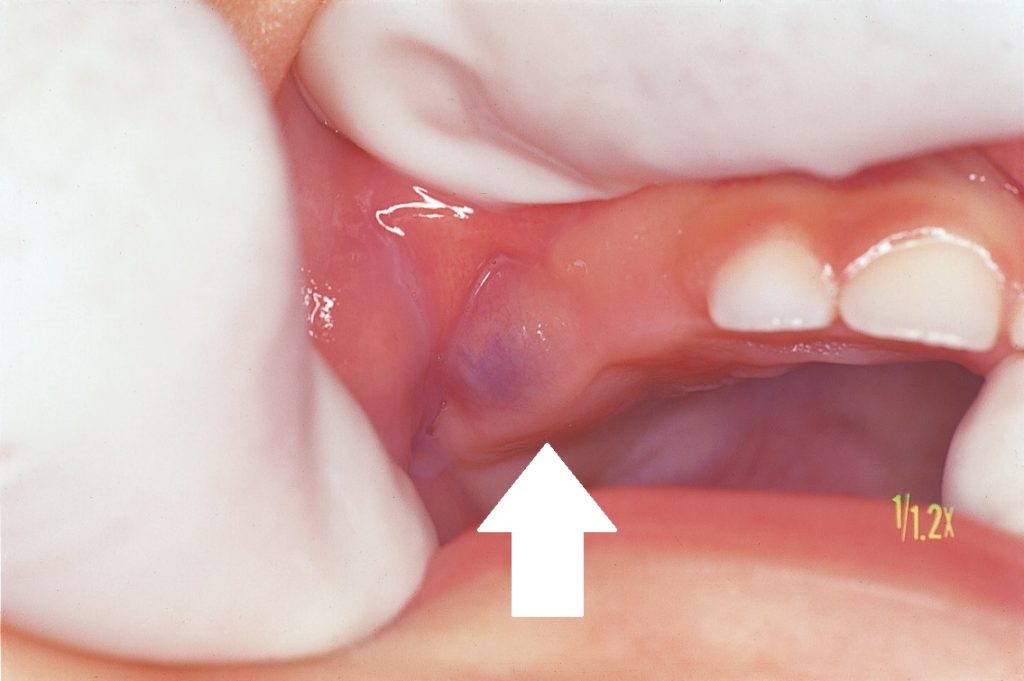 1歳で歯ぐきがぶよぶよ（萌出性囊胞）