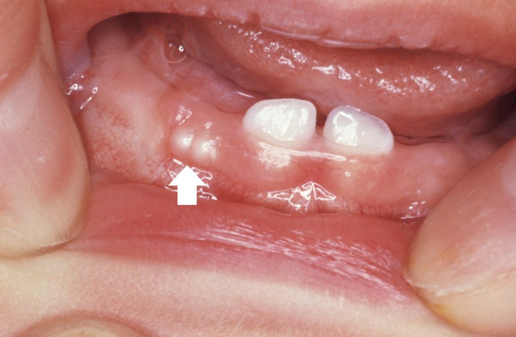 新生児期・乳児期にみられる歯のようなもの（上皮真珠）