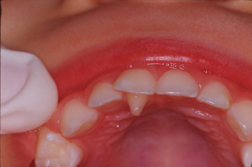 切歯結節、形態異常歯のはなし