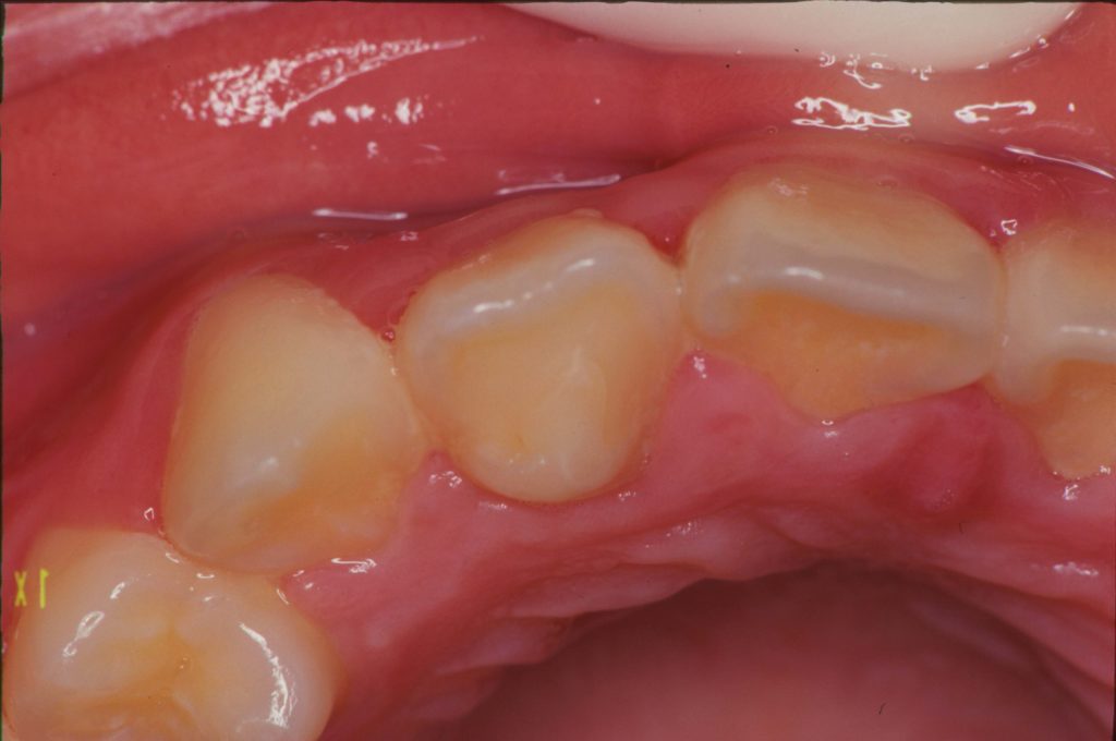 切歯結節、形態異常歯のはなし