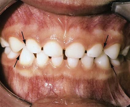 乳歯列がすきっ歯（発育空隙と霊長空隙）