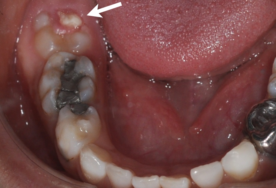 生えてきた奥歯が欠けた（萌出性腐骨）