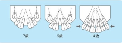 上の前歯（永久歯）の生え方が変？（みにくいあひるの子の時代）