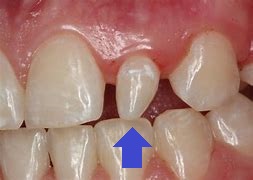 生え代わりの歯の形が変―小さい歯が生えてきた（矮小歯、栓状歯）