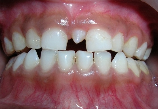 生え代わりの歯の形が変―小さい歯が生えてきた（過剰歯）